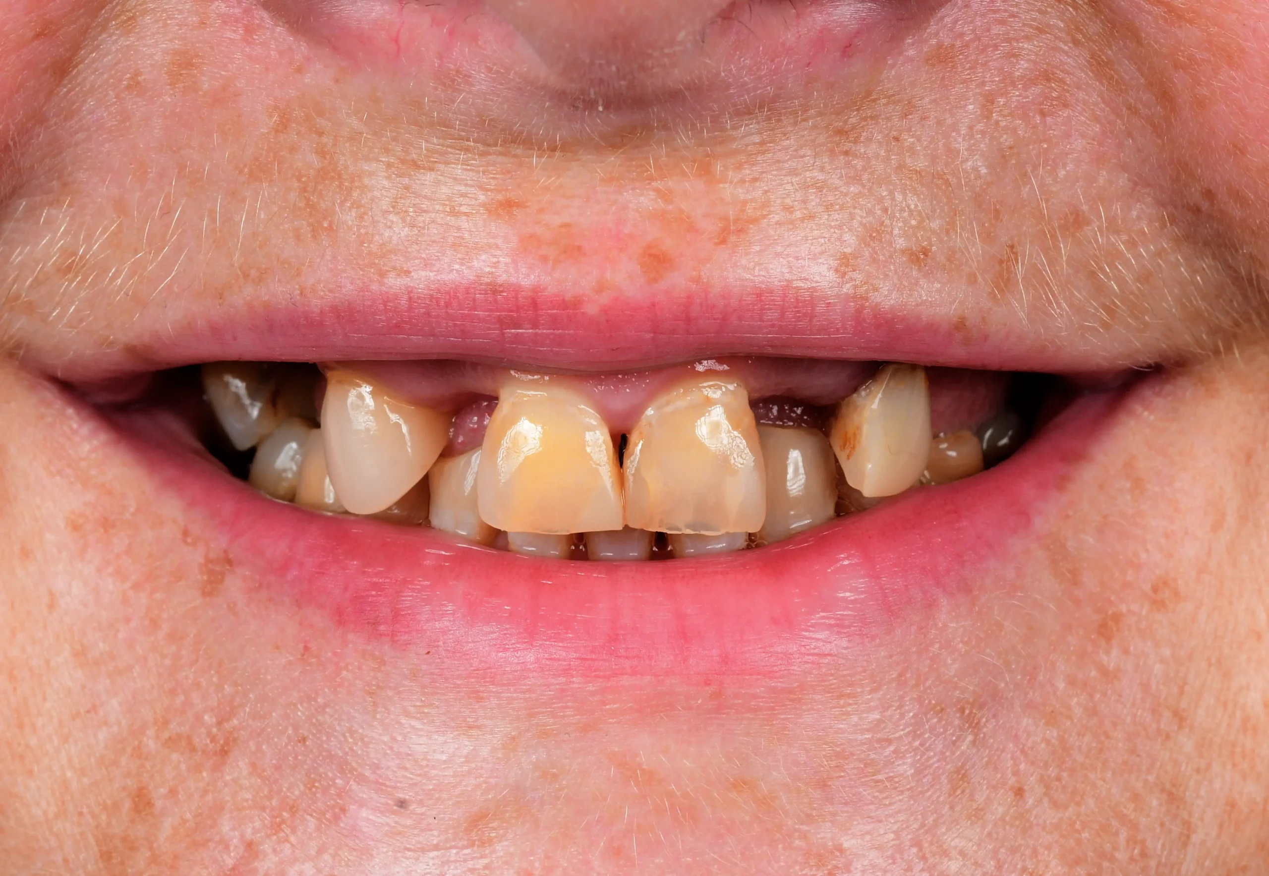 All On 4 Treatment — Before