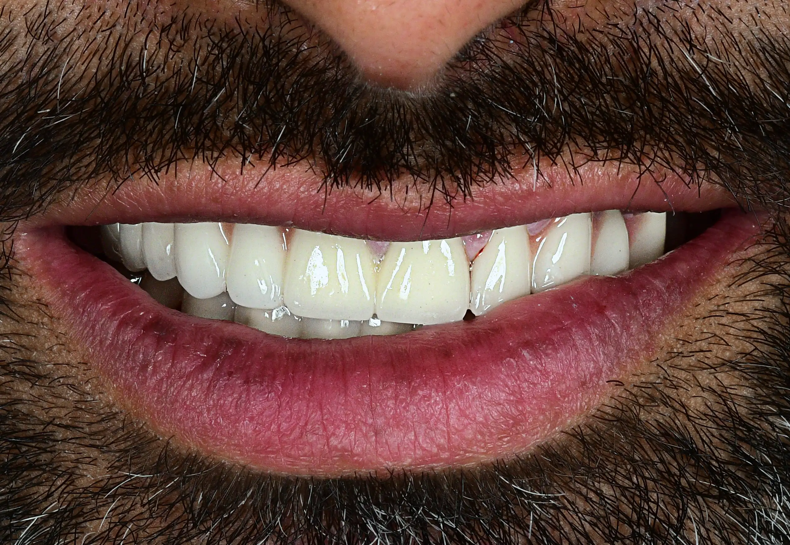 All On 4 Treatment — After