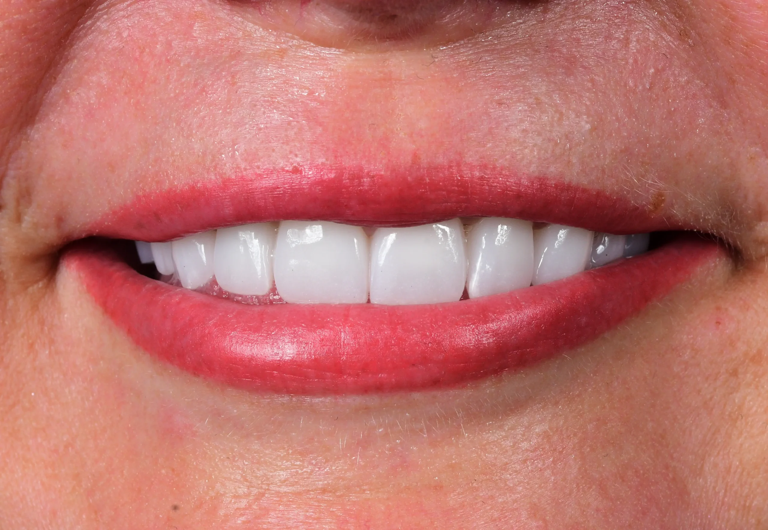 Natural Smile Make Over — After