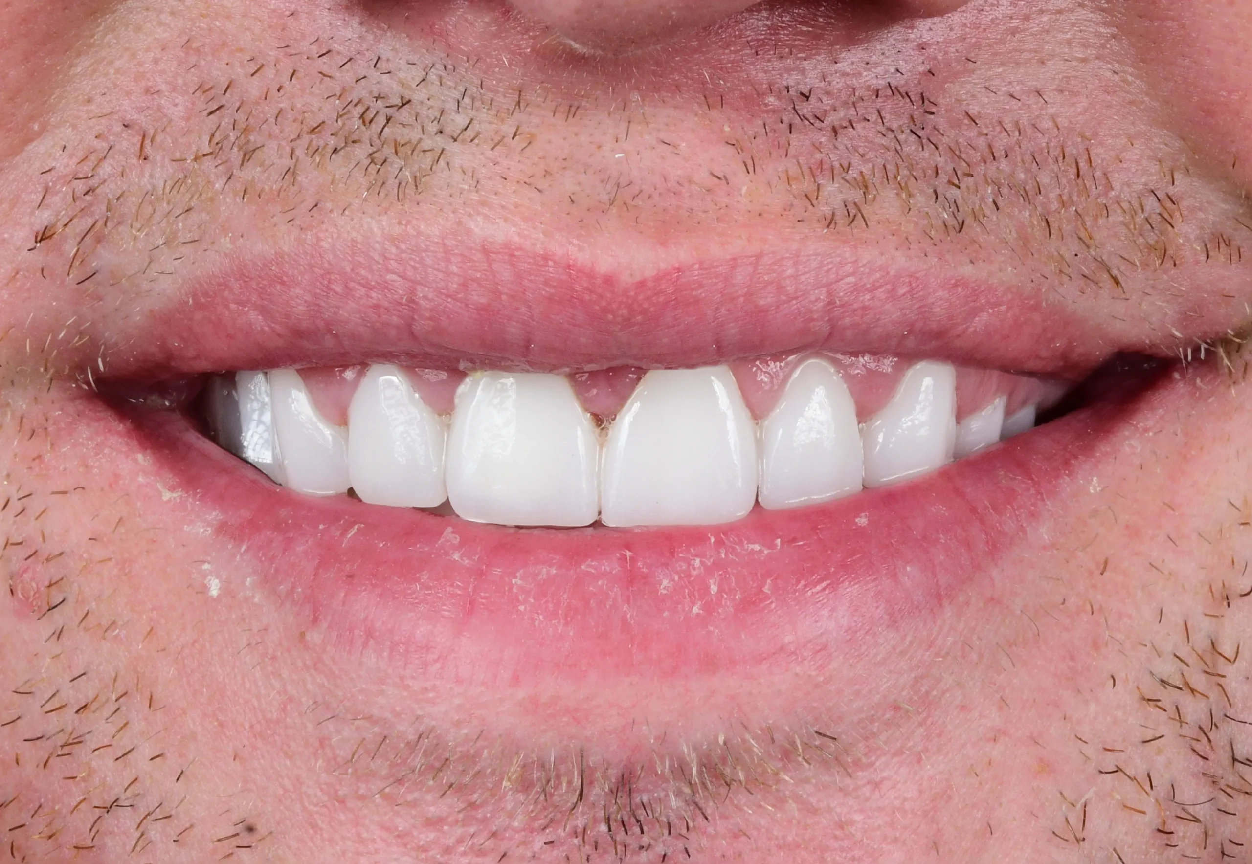 Natural Smile Makeover — After