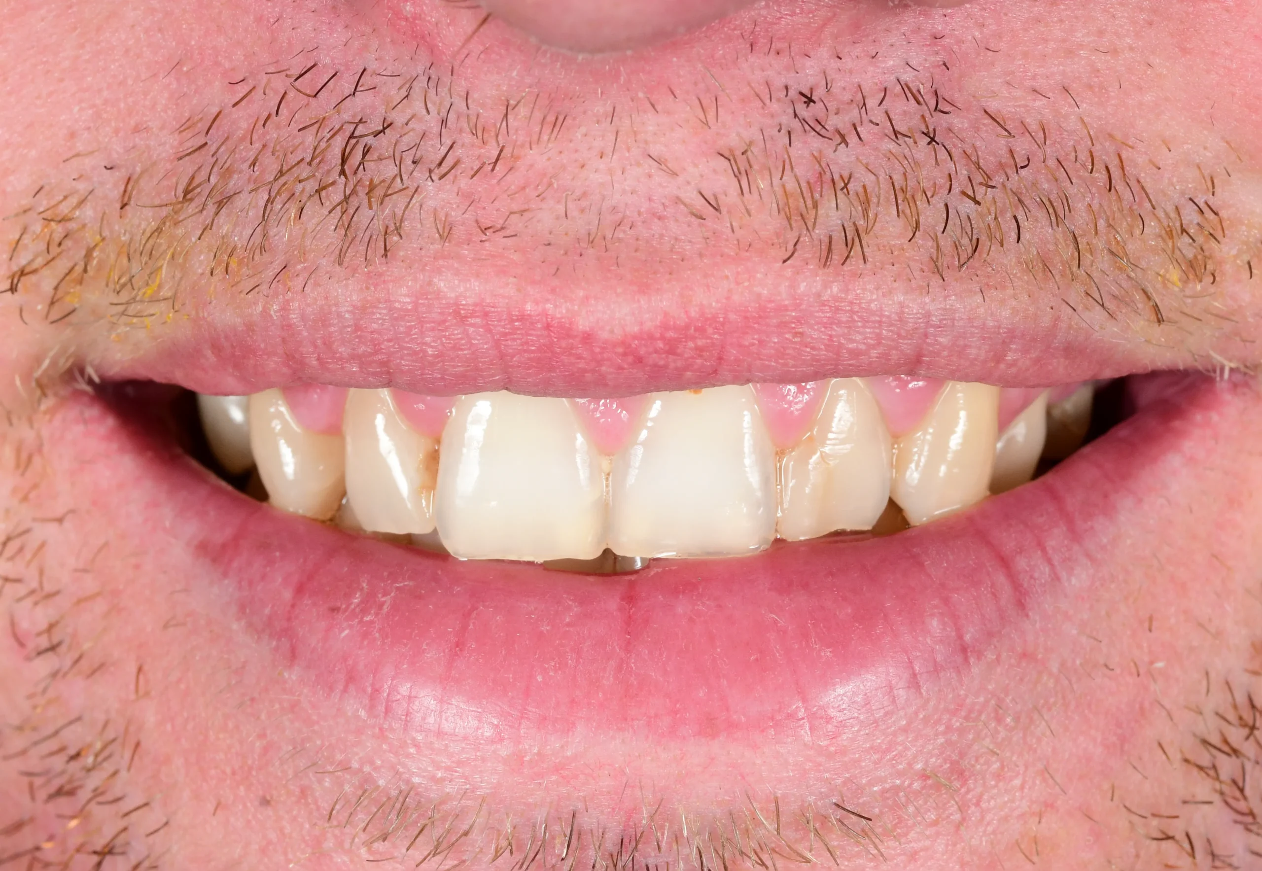 Natural Smile Makeover — Before