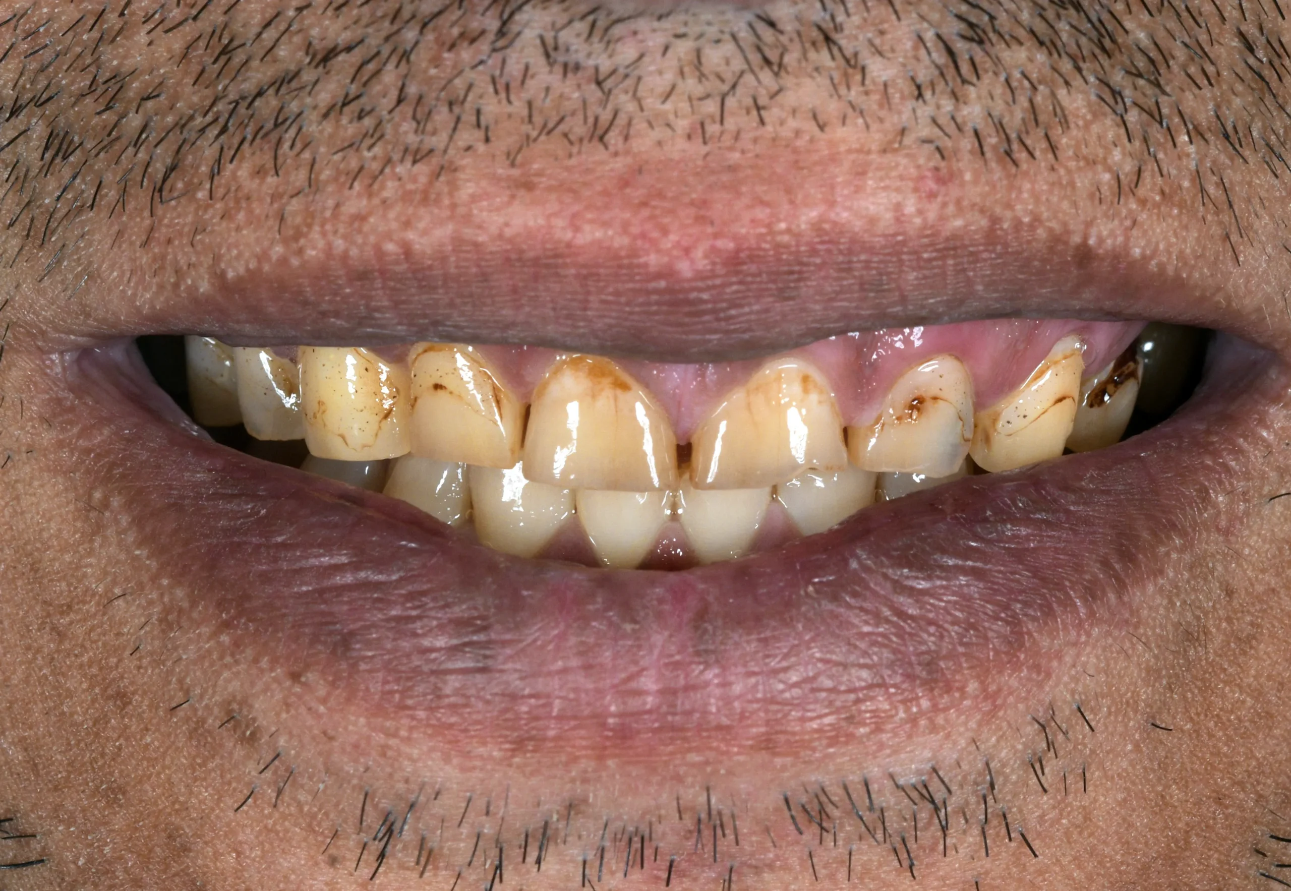 Hollywood Smile Makeover — Before